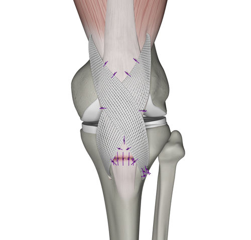 Prótese ligamentar para tendão quadricipital - QuadsTape ™ - Neoligaments - sintética