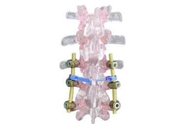 Sistema de osteossíntese cervico-tóraco-lombo-sacral - EVOLUTION PLUS - Ortosintese - via posterior