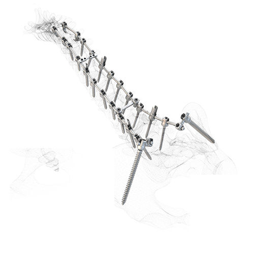 Parafuso pedicular poliaxial - WSI MX/PX®  - Peter Brehm - monoaxial / metálico