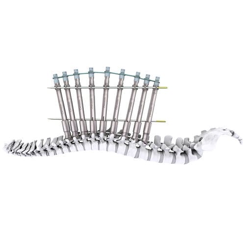 Sistema de posicionamento de parafusos pediculares - mont blanc 3D+ - Spineway