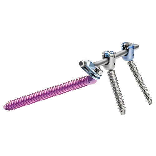 Sistema de osteossíntese sacroilíaco - uBase™ - ulrich medical - via posterior