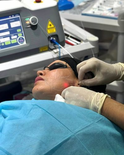 Aparelho de rejuvenescimento da pele a laser - Endolifting - GIGAALASER - com carrinho