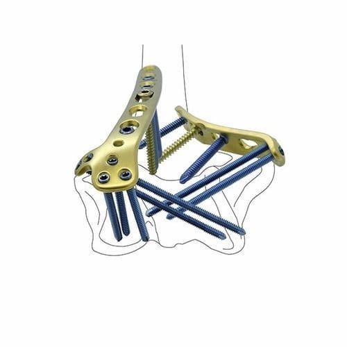 Placa de compressão óssea para úmero - Double Medical Technology - distal / medial / bloqueada