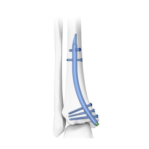 Haste intramedular para tíbia - DTN - Double Medical Technology - fixação distal