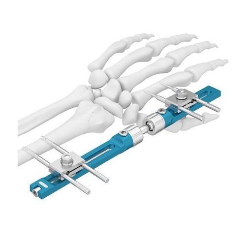 Fixador externo para punho - Double Medical Technology - tubular