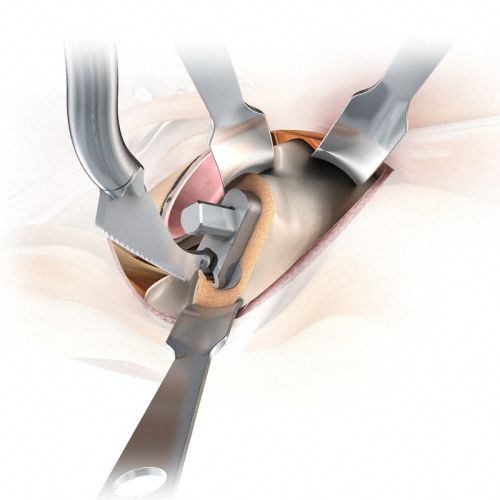 Kit de instrumentos para cirurgia minimamente invasiva do quadril - MIOS&reg; - Aesculap®