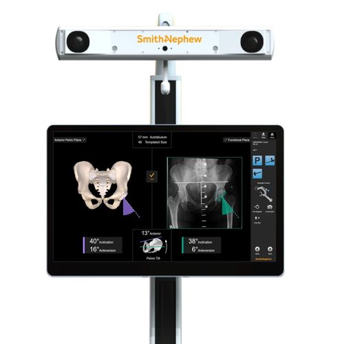 Sistema de navegação cirúrgica para artroplastia do quadril - RI - Smith & Nephew - óptico