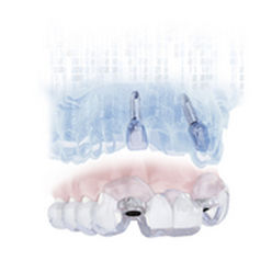 Software de simulação de implante dentário - SIMPLANT® - DENTSPLY Implants GmbH - de planejamento / para implantodontia