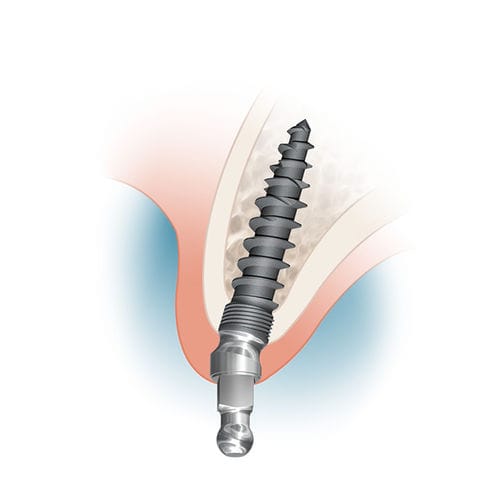 Implante dentário em titânio - MDL2513A, MDL2515A, MDL2518A - Intra-Lock International, Inc.   - bola / angular
