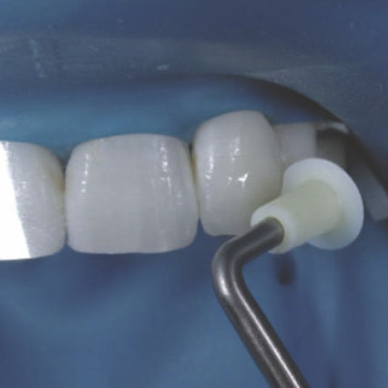Esculpidor para compósito dentário - NA067 - Navadha Enterprises  