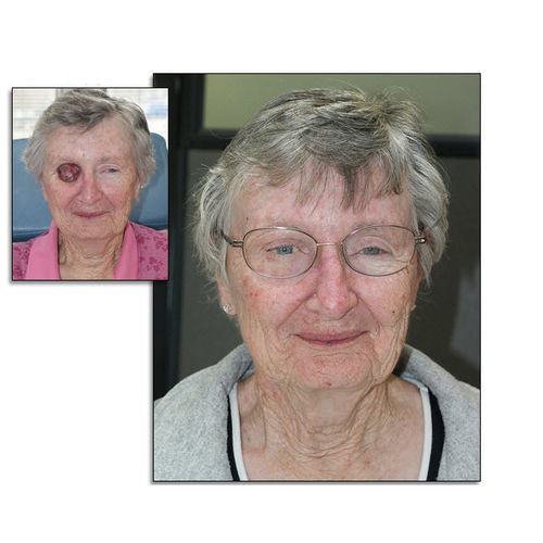 Prótese estética orbital - RealLifeSkin™ - RealLifeSkin - para adulto