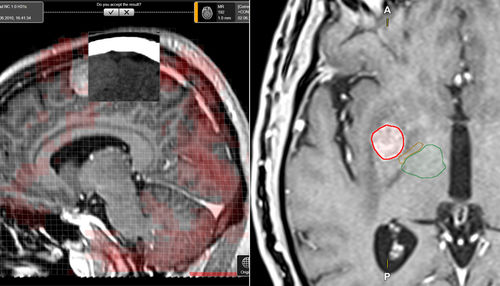 Software de planejamento de tratamento - Elements - Brainlab - médico-hospitalar / para oncologia / automático