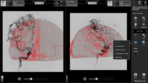 Software de visualização 3D - Brainlab - de diagnóstico / de tratamento / médico-hospitalar