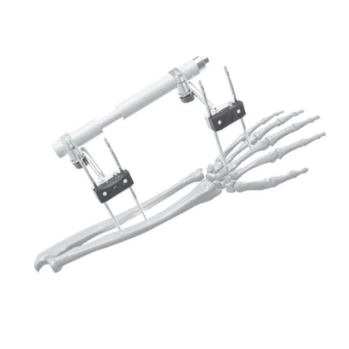 Fixador externo para punho - 206315 - SOFEMED International - tubular
