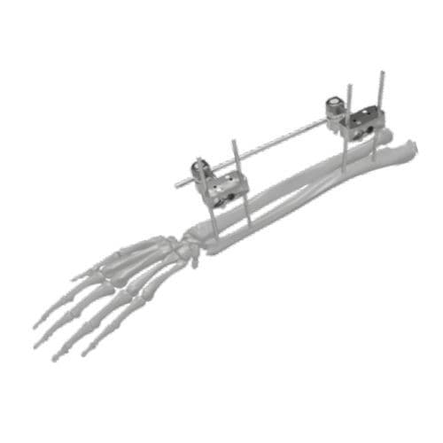 Fixador externo para cúbito - 206302 - SOFEMED International - para rádio / tubular