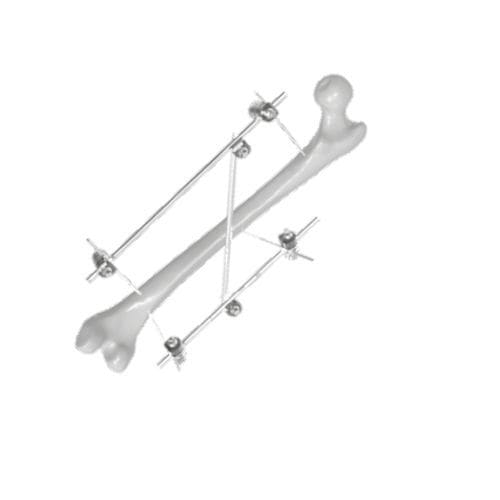 Fixador externo para fêmur - 206307 - SOFEMED International - tubular