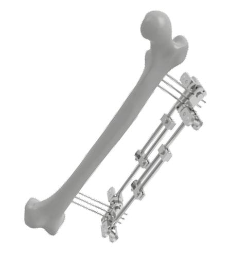 Fixador externo para fêmur - 201502 - SOFEMED International - tubular