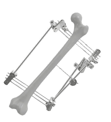 Fixador externo para fêmur - 201504 - SOFEMED International - tubular