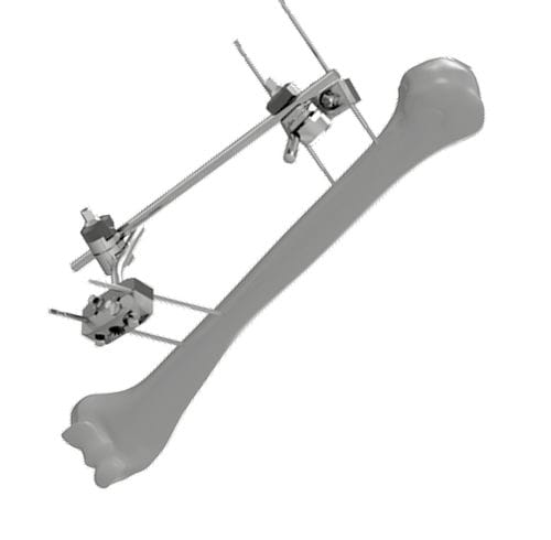 Fixador externo para úmero - 206304 - SOFEMED International - tubular