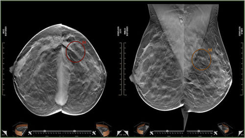Software CAD - MEDI-FUTURE - para rastreamento do câncer de mama / para mamografia / para oncologia