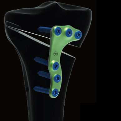Placa de osteotomia para tíbia - Activmotion S   - Newclip Technics - proximal / lateral / metálica