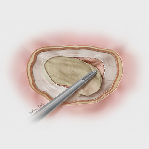 Substituto de dura-máter submucosa de intestino delgado porcino - Biodesign® - COOK Medical