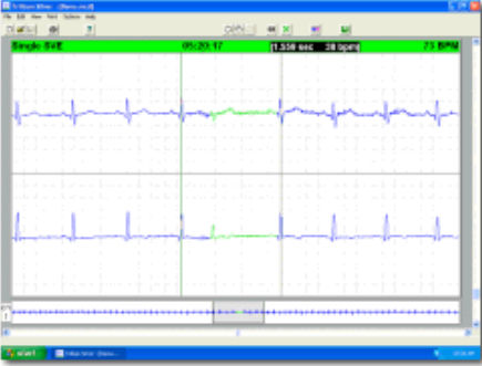 Software de monitorização - Trillium Silver™ - Forest Medical - de análise / médico-hospitalar / para holter cardíaco