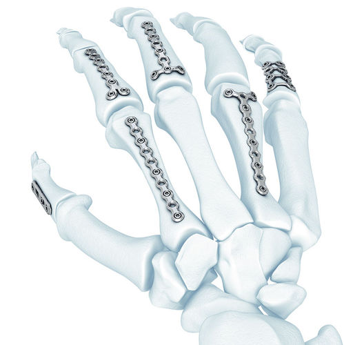 Placa de compressão óssea para metacarpo - LCP® - Depuy Synthes - bloqueada / metálica