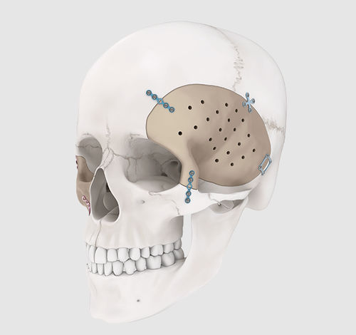 Placa de compressão óssea para mandíbula - MatrixORTHOGNATHIC