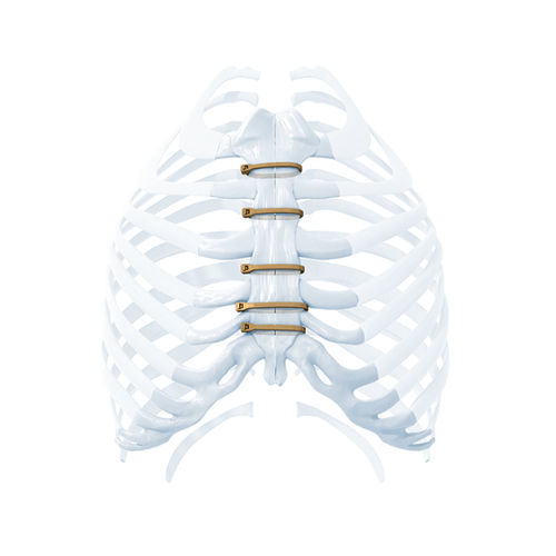 Fio de cerclagem óssea para fechamento do esterno - ZIPFIX™ - Depuy Synthes - monofilamentar metálico