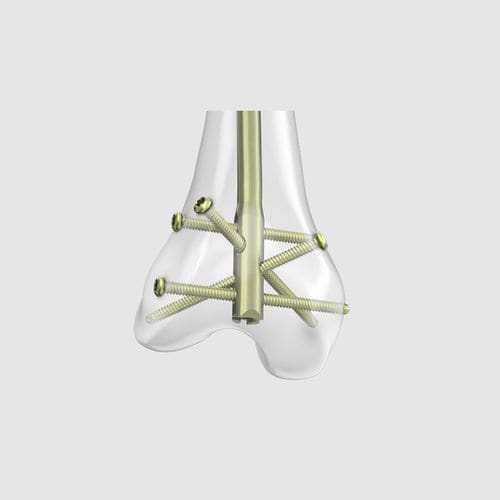 Haste intramedular para fêmur - RFN-ADVANCED™ - Depuy Synthes - fixação distal / metálica