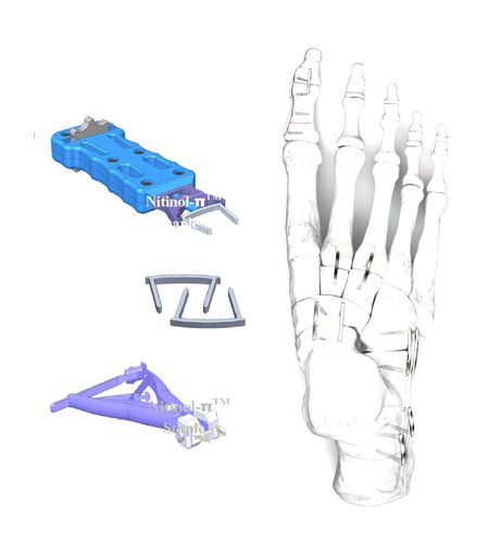 Grampo para pequenos fragmentos ósseos - HJ-π Staple - Health-Joy Medical - para hálux valgo / para artrodese da articulação interfalângica do pé / para osteotomia do calcâneo de Evans