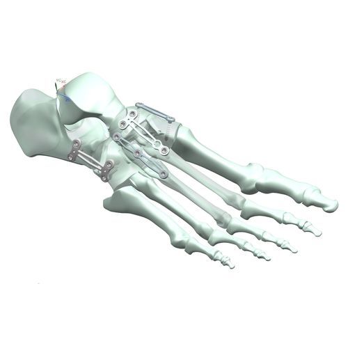 Placa de artrodese para articulação metatarso-falangeana - HJ-Expandable 02 - Health-Joy Medical - para articulação tarsometatársica / para articulação talonavicular / para metatarso