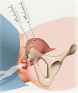 Implante de reconstrução para incontinência urinária - SPARC™ - American Medical Systems - via suprapúbica / para mulher