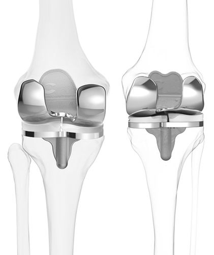 Prótese total de joelho - iTotal® CR - ConforMIS - de deslizamento com preservação do ligamento cruzado / cimentada