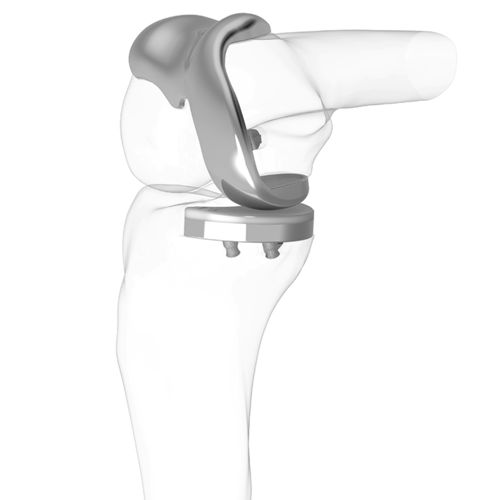 Prótese de joelho parcial - iDuo®  - ConforMIS - com plataforma fixa / cimentada