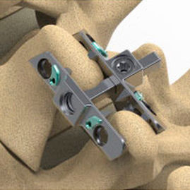 Implante vertebral interespinhoso lombar - Reli™ SP - Precision Spine - sacral / torácico