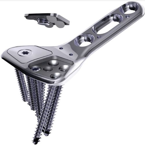Placa de compressão óssea para rádio - COVERLOC™ - Wright Medical Technology - distal / bloqueada / metálica