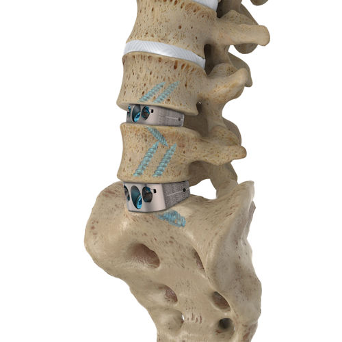Espaçador intervertebral lombossacral - IdentiTi™ ALIF Standalone - Alphatec Spine - via anterior / em titânio