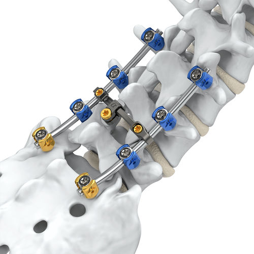 Sistema de osteossíntese lombossacral - Arsenal™  - Alphatec Spine - via posterior