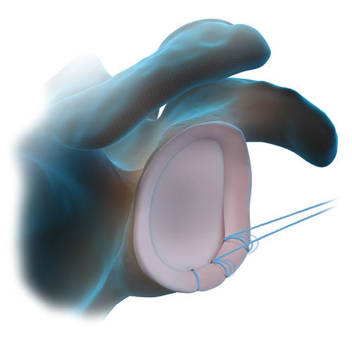 Âncora de sutura lábrum glenoidal - FiberTak® - Arthrex - não absorvível / sem nós