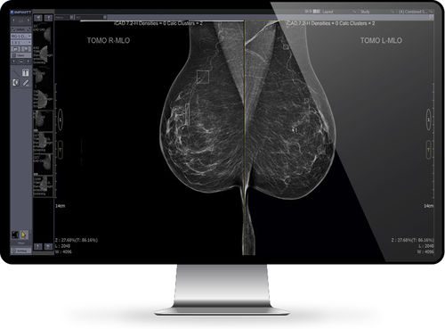 PACS para exames de imagem - Mammo - INFINITT North America