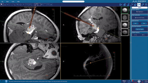 Software de planejamento - NeuroBlate ® SoftwareTM NeuroBlate ® - Monteris Medical - de aquisição / de contorno / para exames de imagem