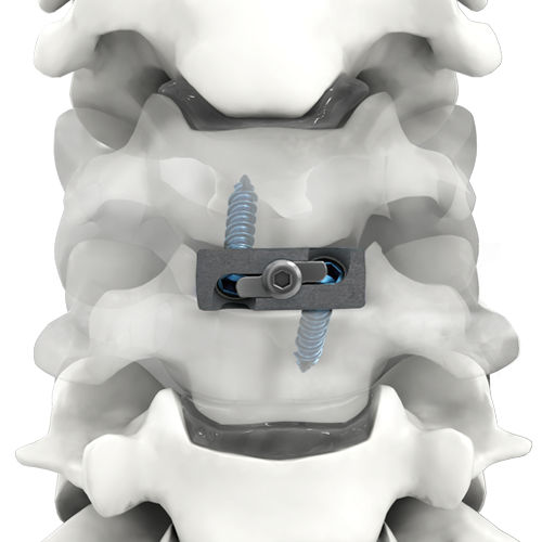 Espaçador intervertebral cervical - PRO-LINK® - Life Spine - via anterior / em titânio