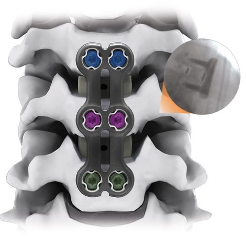 Placa de artrodese para vértebra cervical - IRIS® - Life Spine - bloqueada / 2 níveis