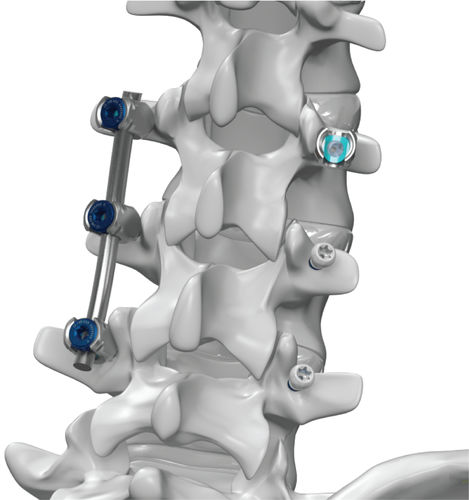 Sistema de osteossíntese toracolombar - ARx® - Life Spine - via posterior