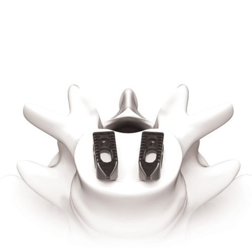 Espaçador intervertebral toracolombar - PLATEAU®-Ti - Life Spine - via anterior / em titânio