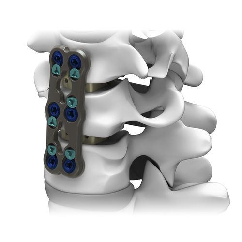 Placa para artrodese cervical - GRUVE™ - Life Spine - bloqueada / metálica / 2 níveis