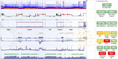 Software de análise - Noxturnal™ - Nox Medical - de criação de laudos / de gravação / para polissonografia
