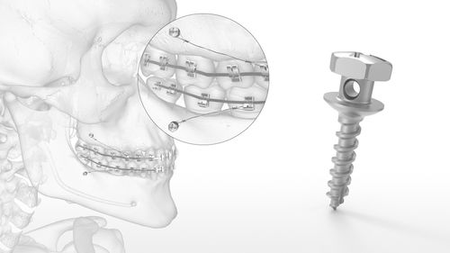 Mini-implante em titânio - OMI™ - Acumed - de parafuso / de ancoragem ortodôntica / cortical